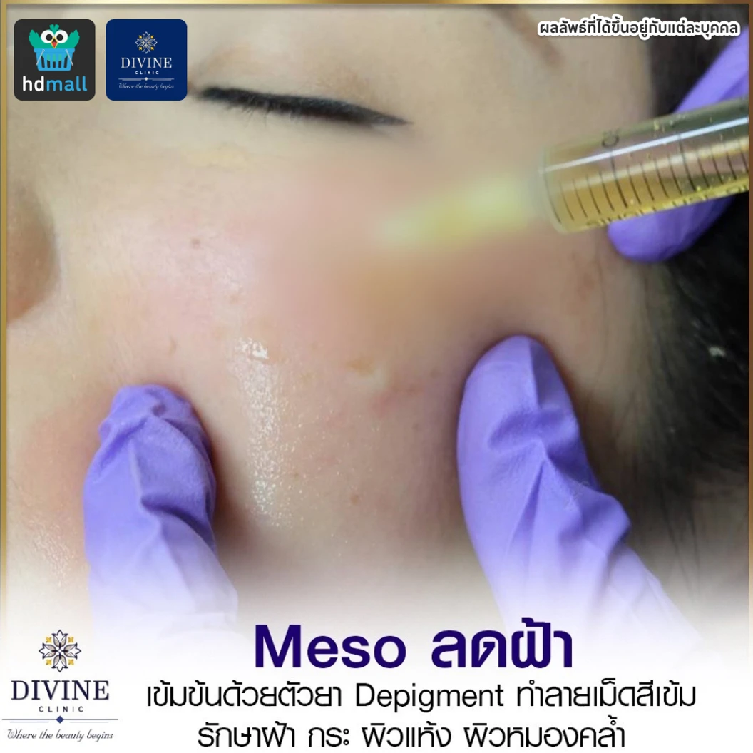 โปรแกรม Meso Depigment 1 ขวด 3 มล. ลดฝ้า กระ เม็ดสีเข้ม ปรับผิวกระจ่างใส 1 ครั้ง