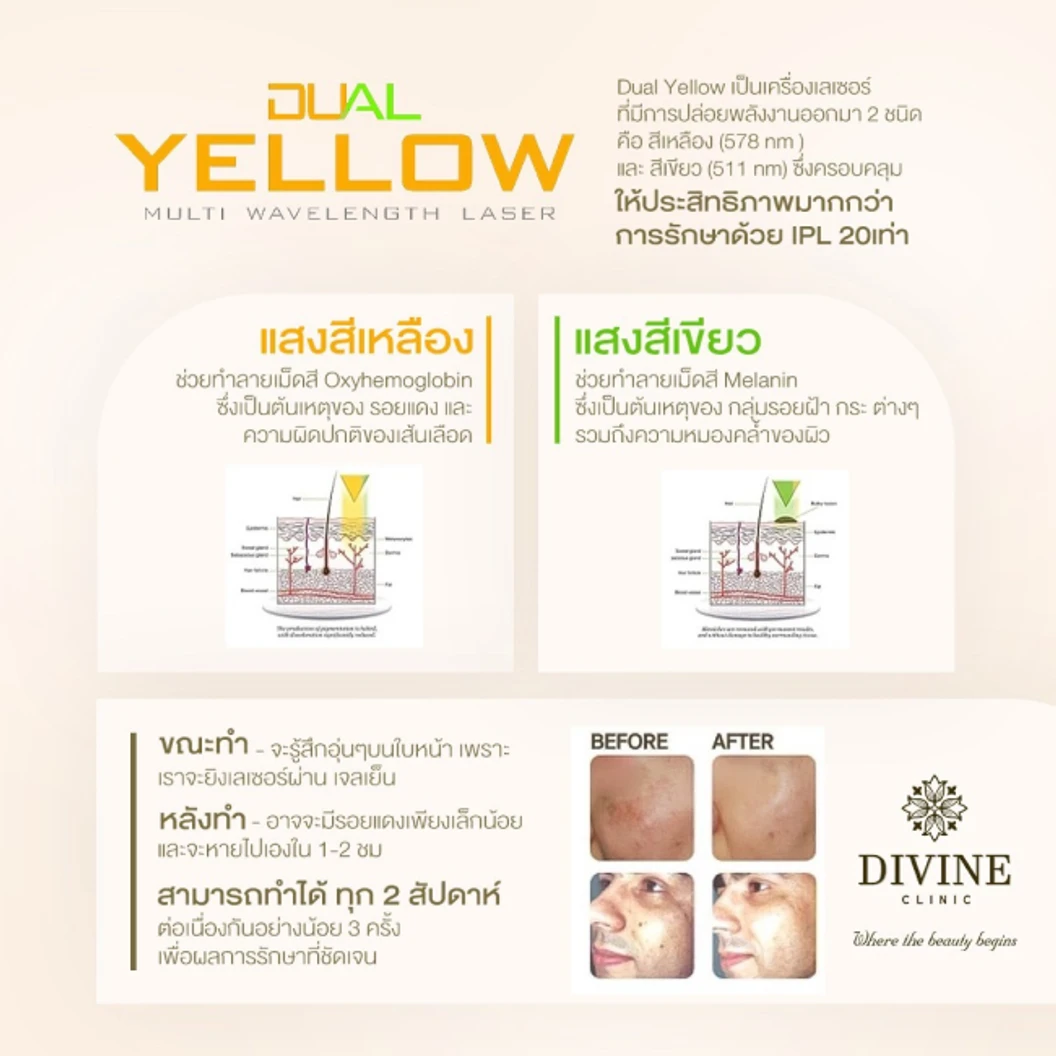 โปรแกรมรักษาฝ้า 3 ขั้นตอน (Dual Yellow Melasma Mode) 1 ครั้ง