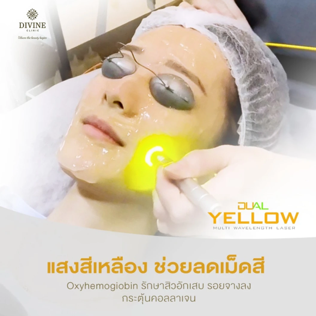โปรแกรมรักษาฝ้า 3 ขั้นตอน (Dual Yellow Melasma Mode) 1 ครั้ง