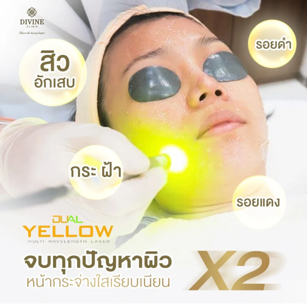 โปรแกรมรักษาฝ้า 3 ขั้นตอน (Dual Yellow Melasma Mode) 1 ครั้ง