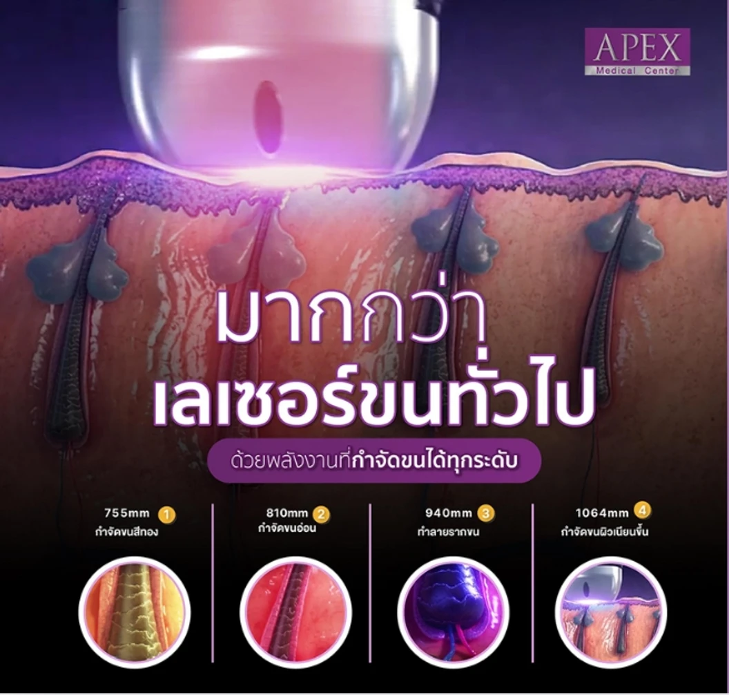 เลเซอร์ Dynamic Tech กำจัดขน Bikini (V) 1 ครั้ง (ราคาทดลอง)
