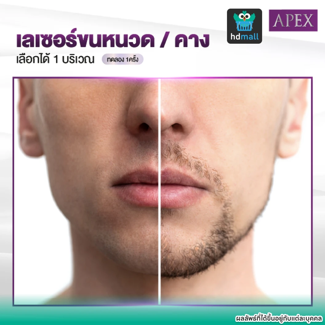 เลเซอร์ Dynamic Tech กำจัดขนหนวดหรือคาง 1 ครั้ง (ราคาทดลอง)