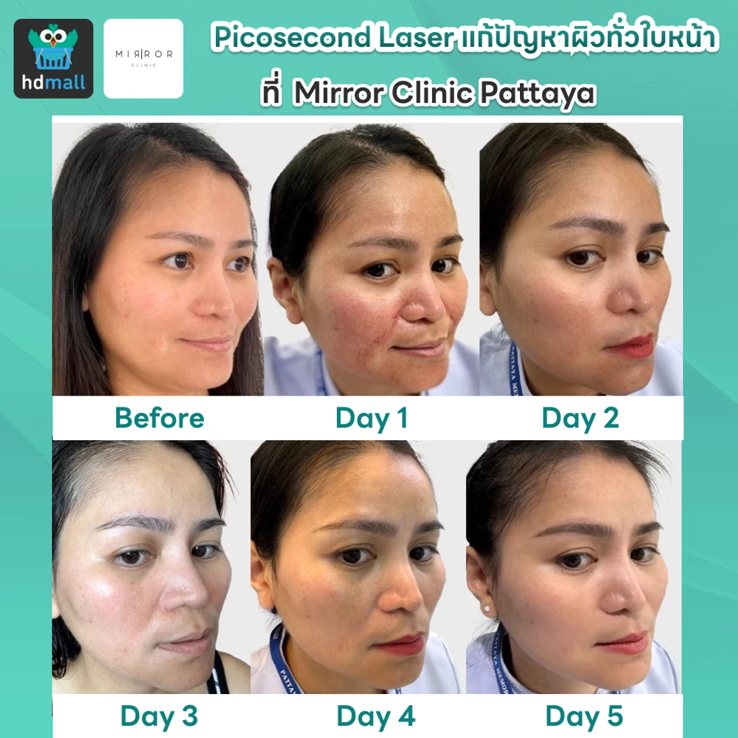Picosecond Laser แก้ปัญหาผิวทั่วใบหน้า 1 ครั้ง จำกัด 1 ท่านต่อ 1 สิทธิ์ เท่านั้น