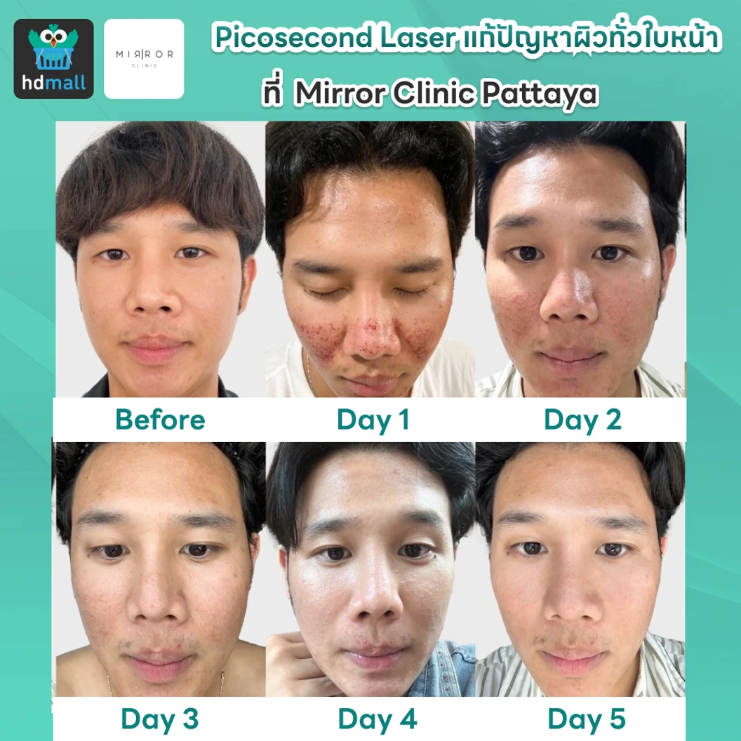 Picosecond Laser แก้ปัญหาผิวทั่วใบหน้า 1 ครั้ง จำกัด 1 ท่านต่อ 1 สิทธิ์ เท่านั้น