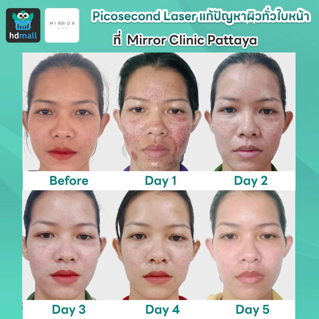 Picosecond Laser แก้ปัญหาผิวทั่วใบหน้า 1 ครั้ง จำกัด 1 ท่านต่อ 1 สิทธิ์ เท่านั้น