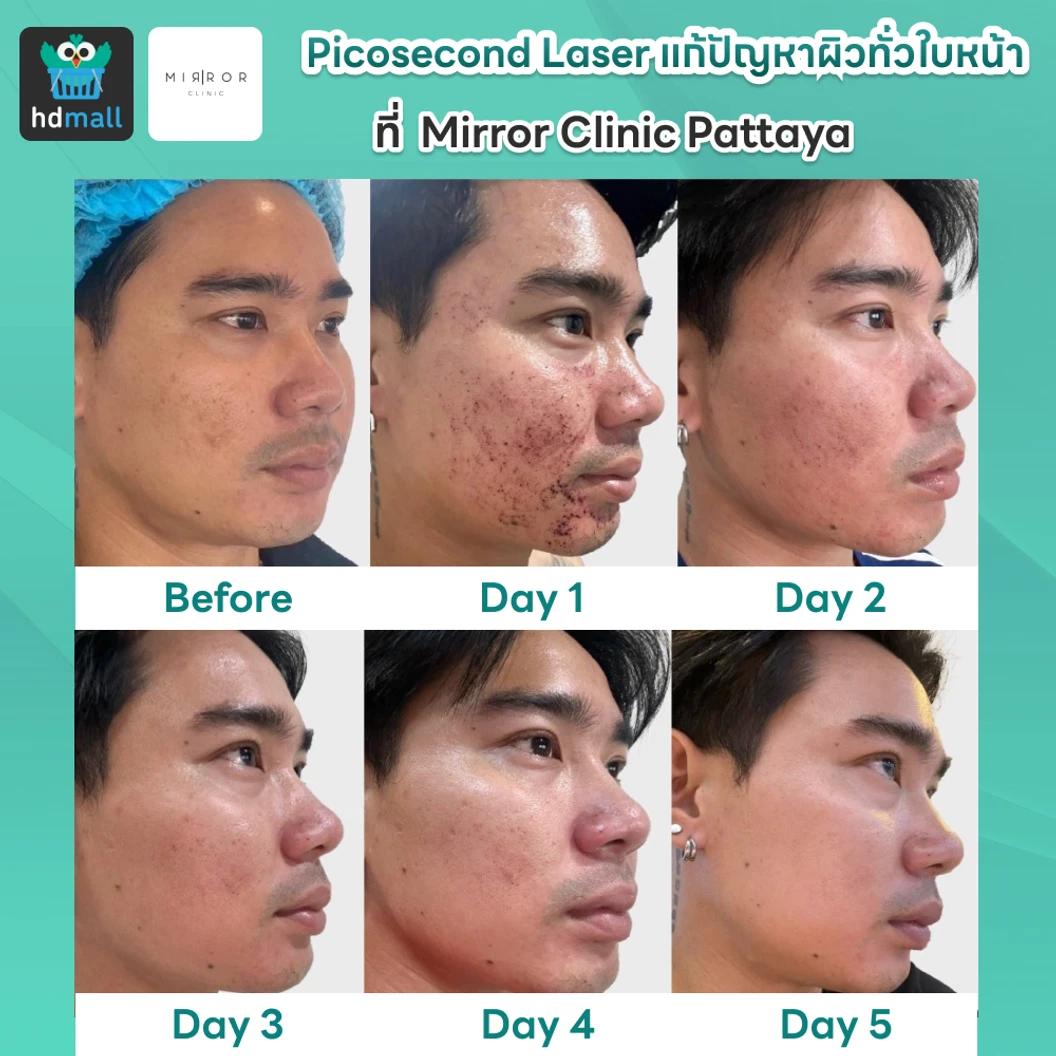 Picosecond Laser แก้ปัญหาผิวทั่วใบหน้า 1 ครั้ง จำกัด 1 ท่านต่อ 1 สิทธิ์ เท่านั้น
