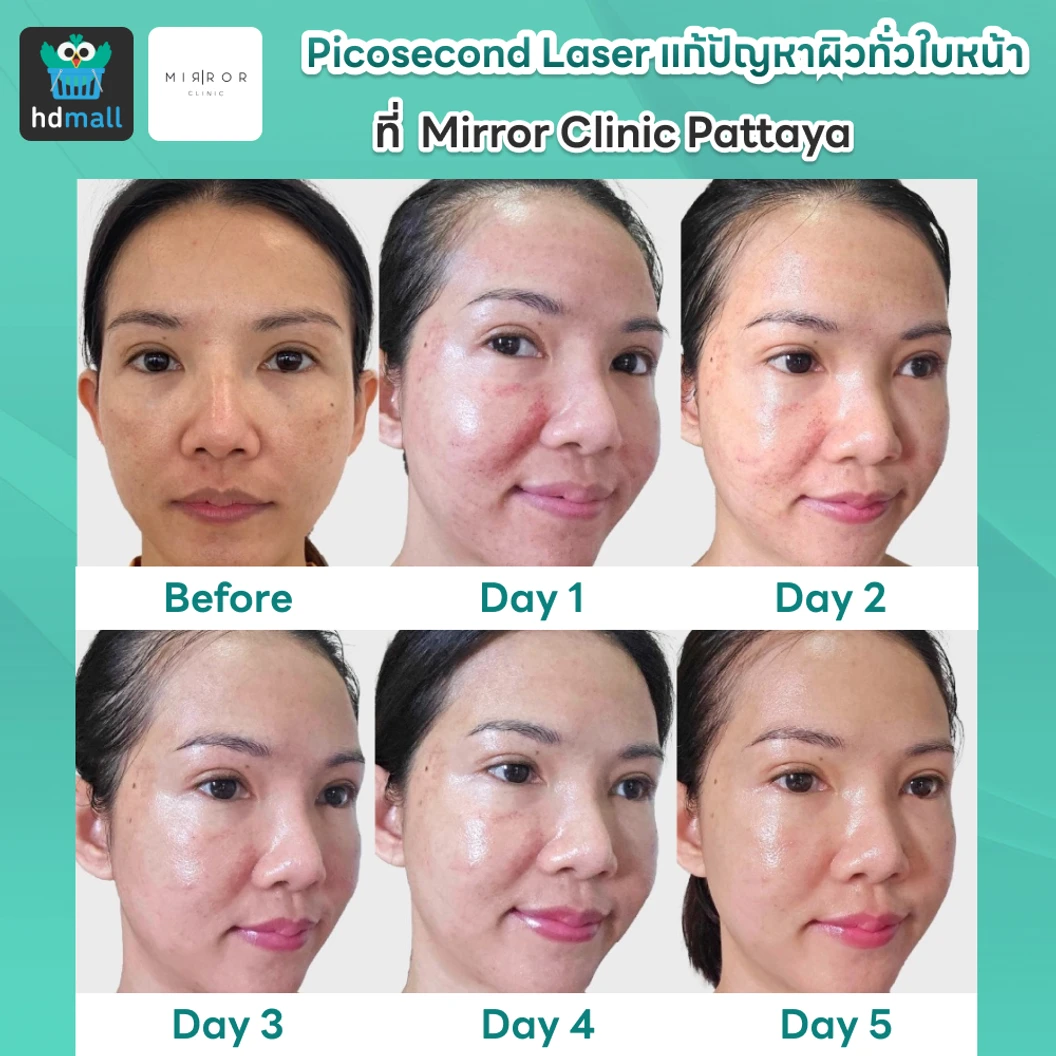 Picosecond Laser แก้ปัญหาผิวทั่วใบหน้า 1 ครั้ง จำกัด 1 ท่านต่อ 1 สิทธิ์ เท่านั้น