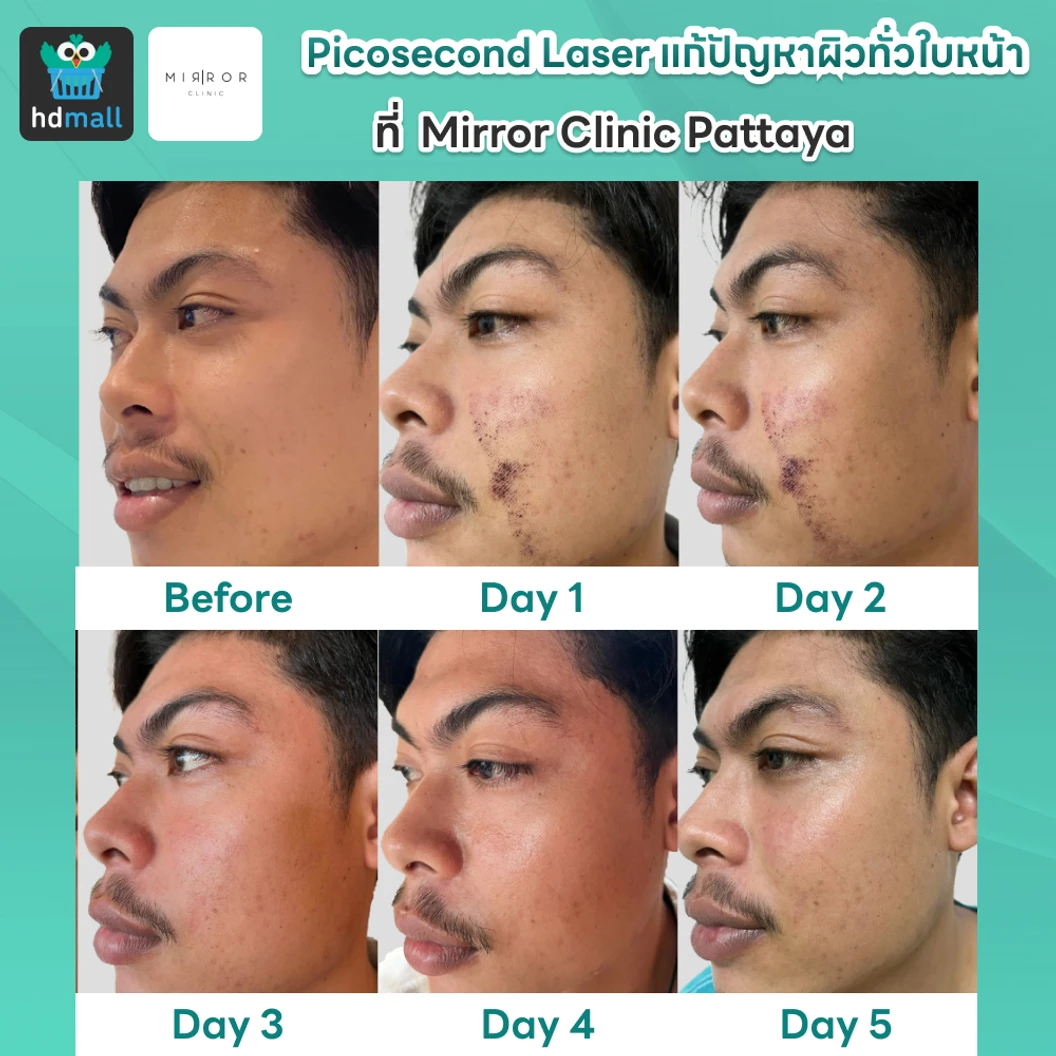 Picosecond Laser แก้ปัญหาผิวทั่วใบหน้า 1 ครั้ง จำกัด 1 ท่านต่อ 1 สิทธิ์ เท่านั้น