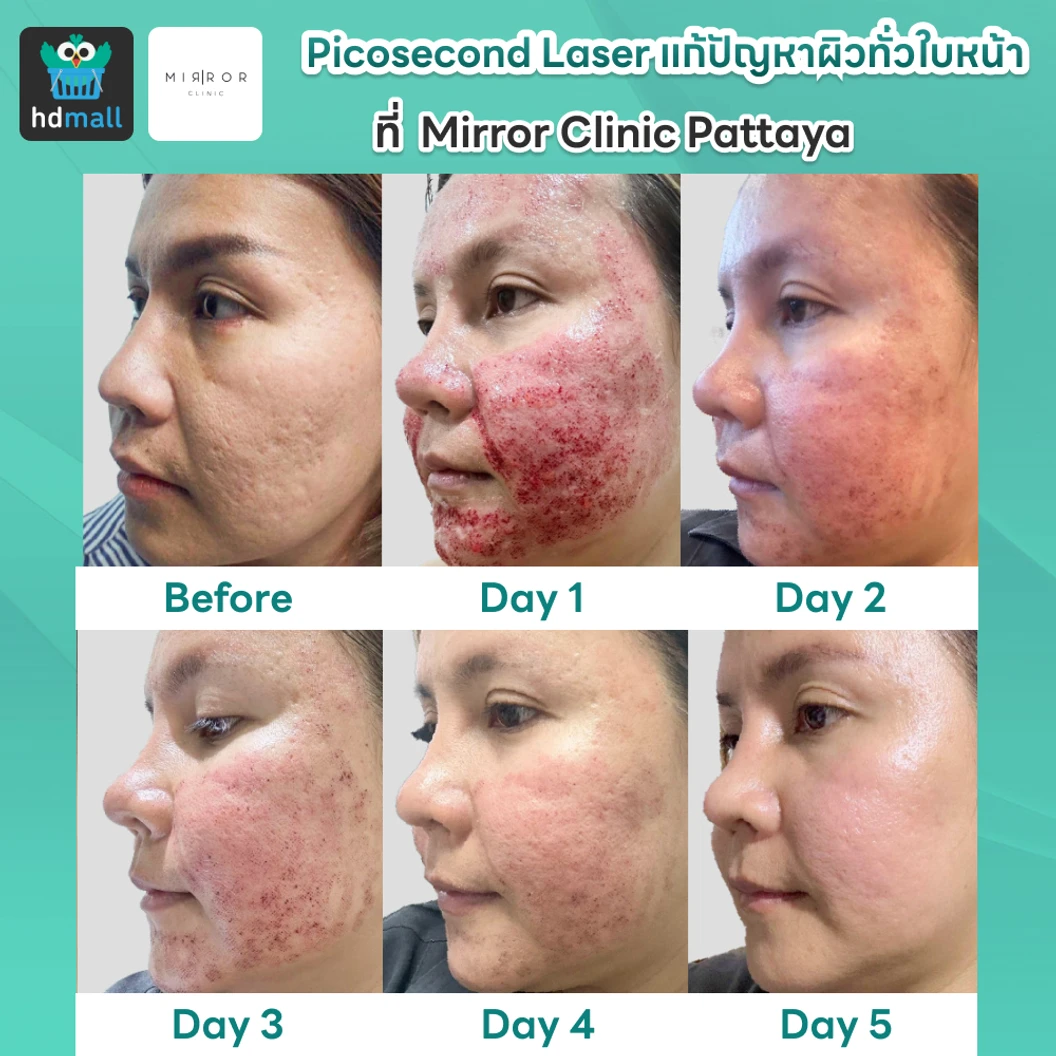 Picosecond Laser แก้ปัญหาผิวทั่วใบหน้า 1 ครั้ง จำกัด 1 ท่านต่อ 1 สิทธิ์ เท่านั้น