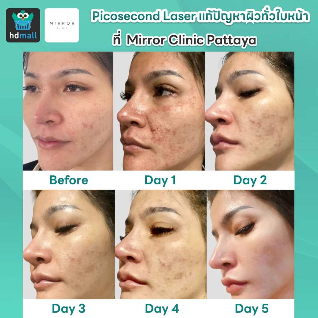 Picosecond Laser แก้ปัญหาผิวทั่วใบหน้า 1 ครั้ง จำกัด 1 ท่านต่อ 1 สิทธิ์ เท่านั้น