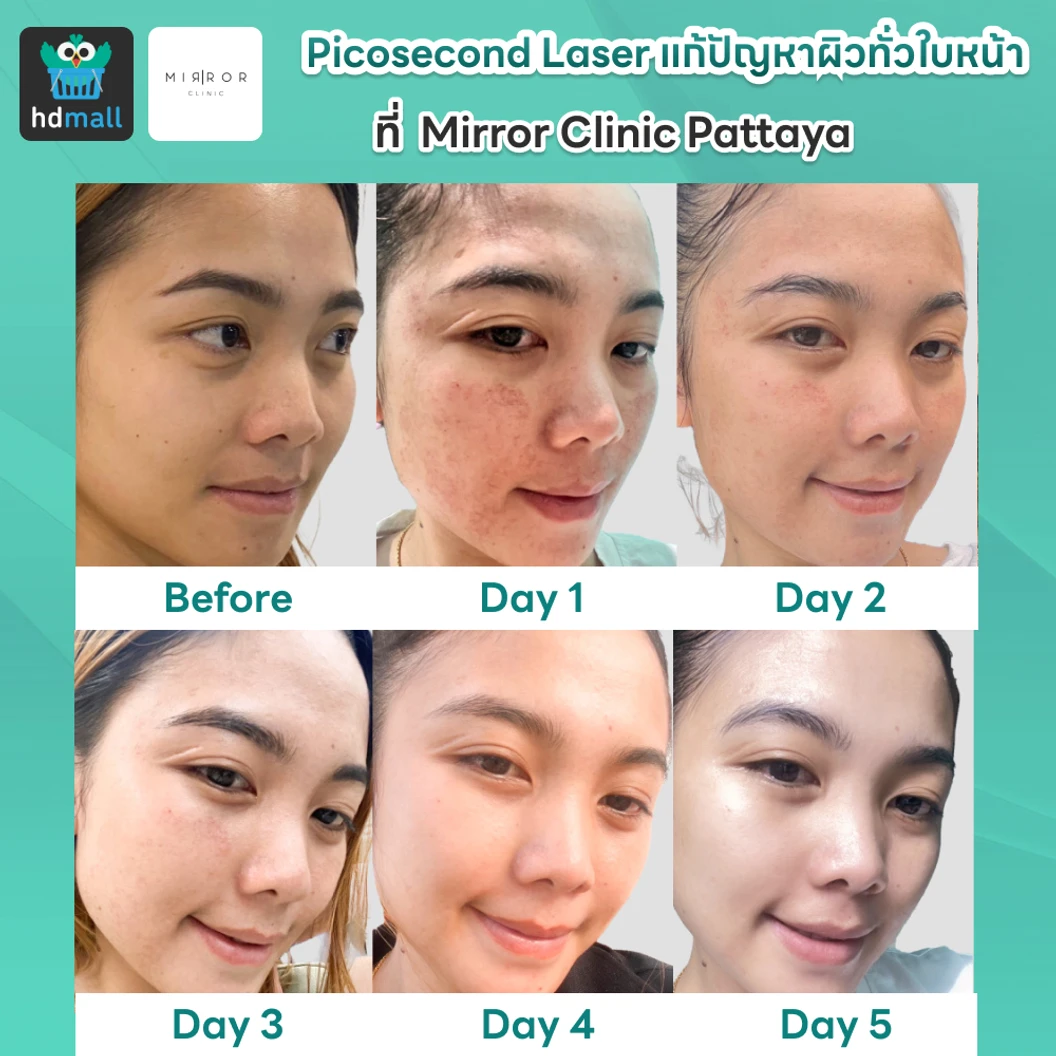 Picosecond Laser แก้ปัญหาผิวทั่วใบหน้า 1 ครั้ง จำกัด 1 ท่านต่อ 1 สิทธิ์ เท่านั้น