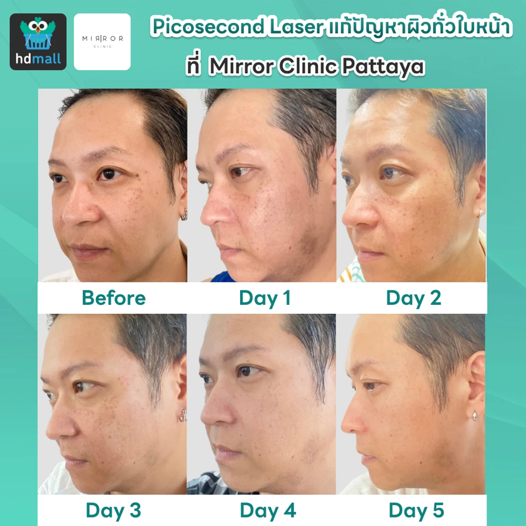 Picosecond Laser แก้ปัญหาผิวทั่วใบหน้า 1 ครั้ง จำกัด 1 ท่านต่อ 1 สิทธิ์ เท่านั้น