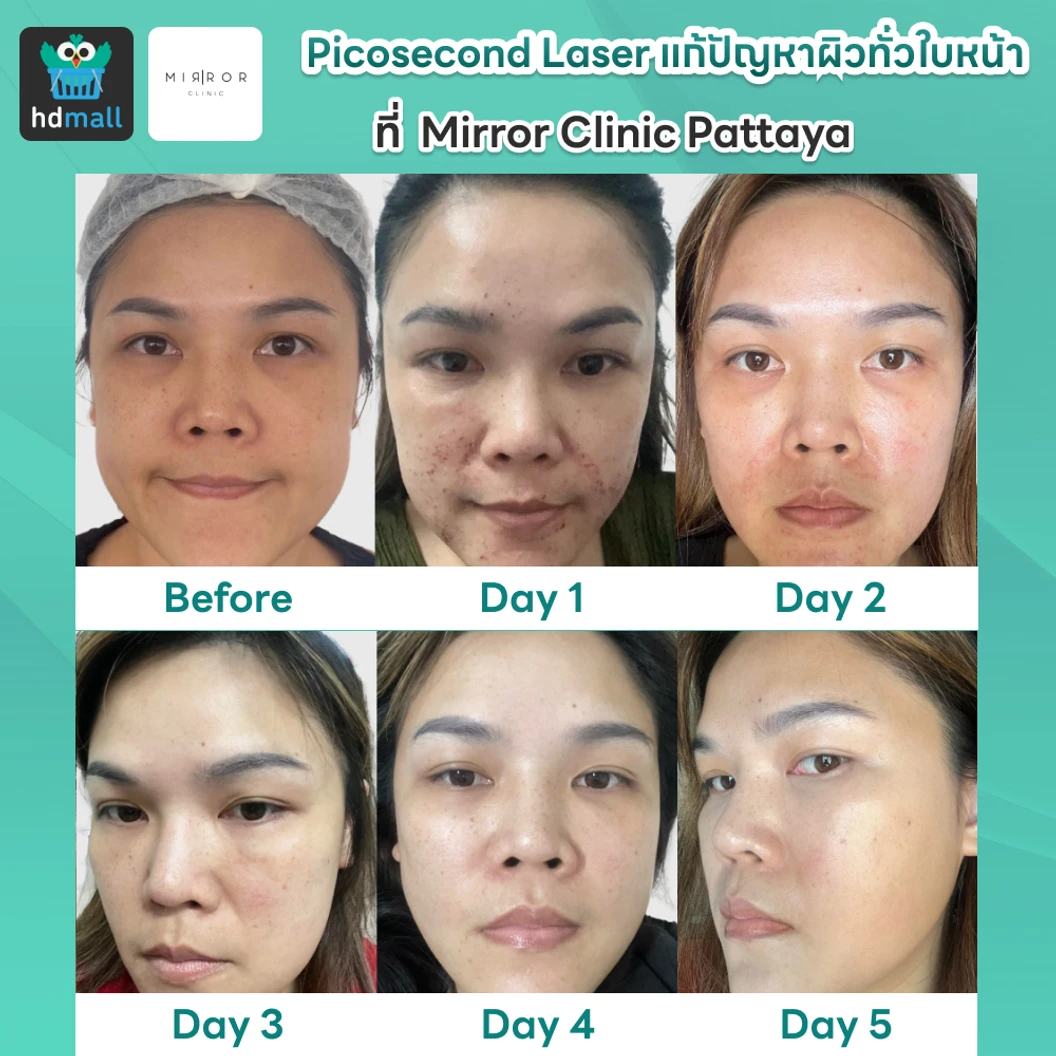 Picosecond Laser แก้ปัญหาผิวทั่วใบหน้า 1 ครั้ง จำกัด 1 ท่านต่อ 1 สิทธิ์ เท่านั้น