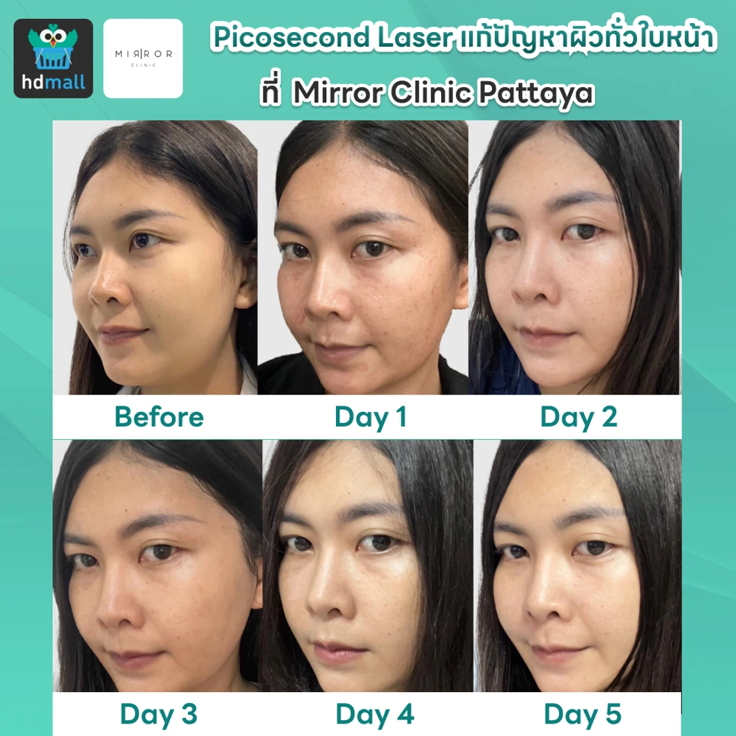 Picosecond Laser แก้ปัญหาผิวทั่วใบหน้า 1 ครั้ง จำกัด 1 ท่านต่อ 1 สิทธิ์ เท่านั้น