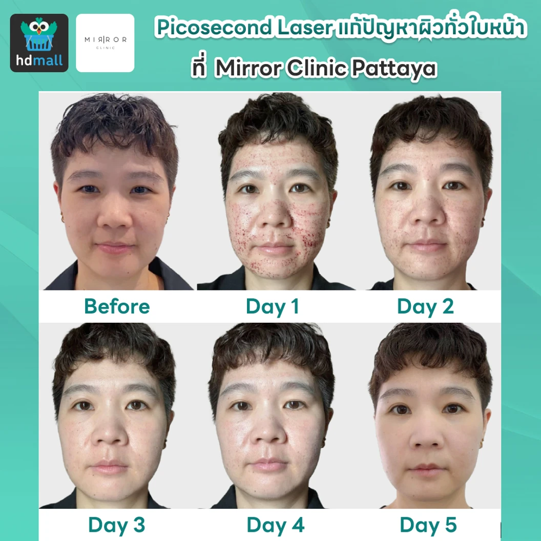 Picosecond Laser แก้ปัญหาผิวทั่วใบหน้า 1 ครั้ง จำกัด 1 ท่านต่อ 1 สิทธิ์ เท่านั้น