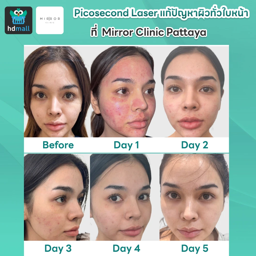 Picosecond Laser แก้ปัญหาผิวทั่วใบหน้า 1 ครั้ง จำกัด 1 ท่านต่อ 1 สิทธิ์ เท่านั้น