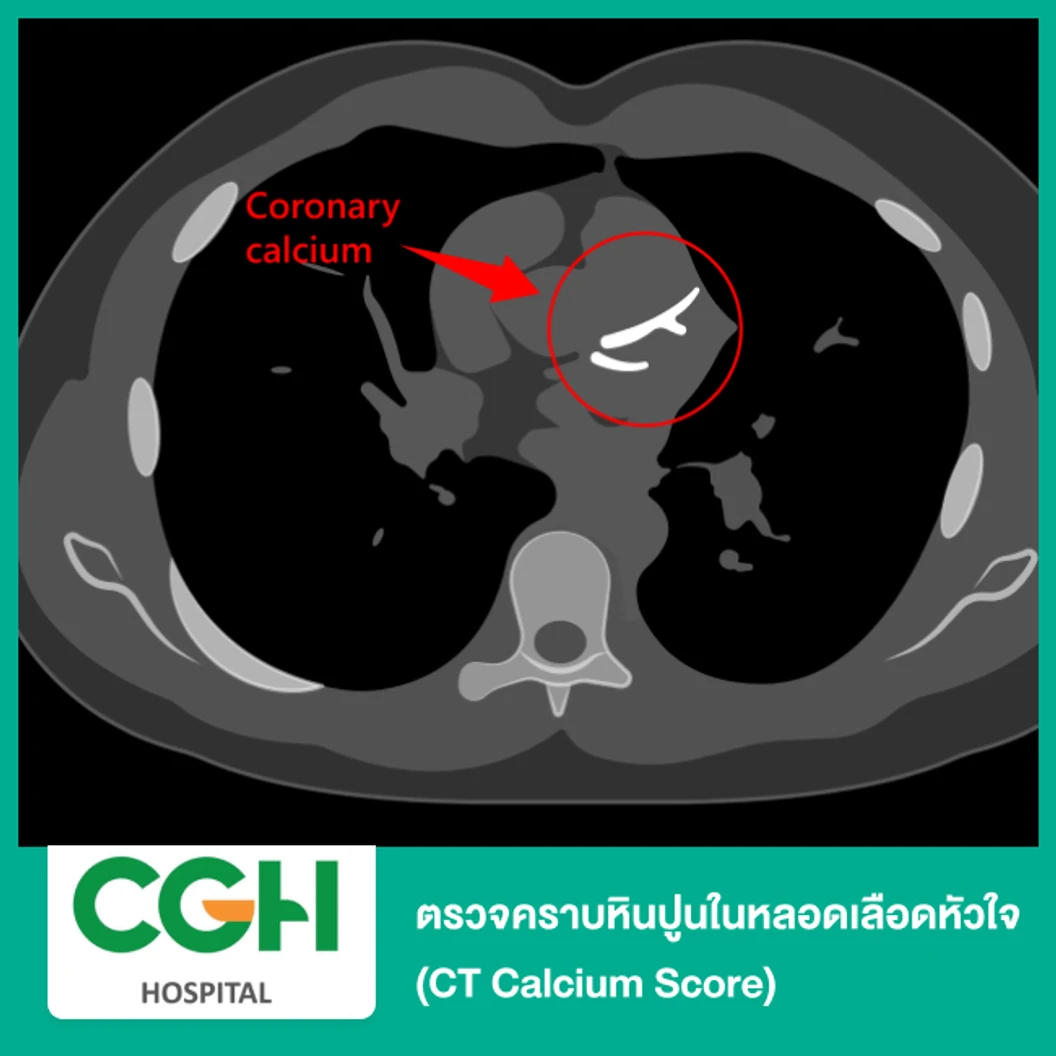 ตรวจคราบหินปูนในหลอดเลือดหัวใจ (CT Calcium Score)