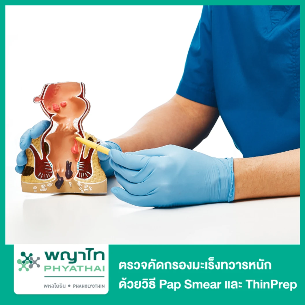 ตรวจคัดกรองมะเร็งทวารหนัก ด้วยวิธี Pap Smear และ ThinPrep
