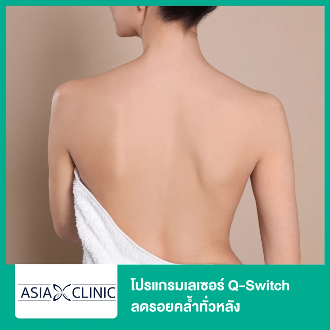 โปรแกรมเลเซอร์ Q-Switch ลดรอยคล้ำทั่วหลัง