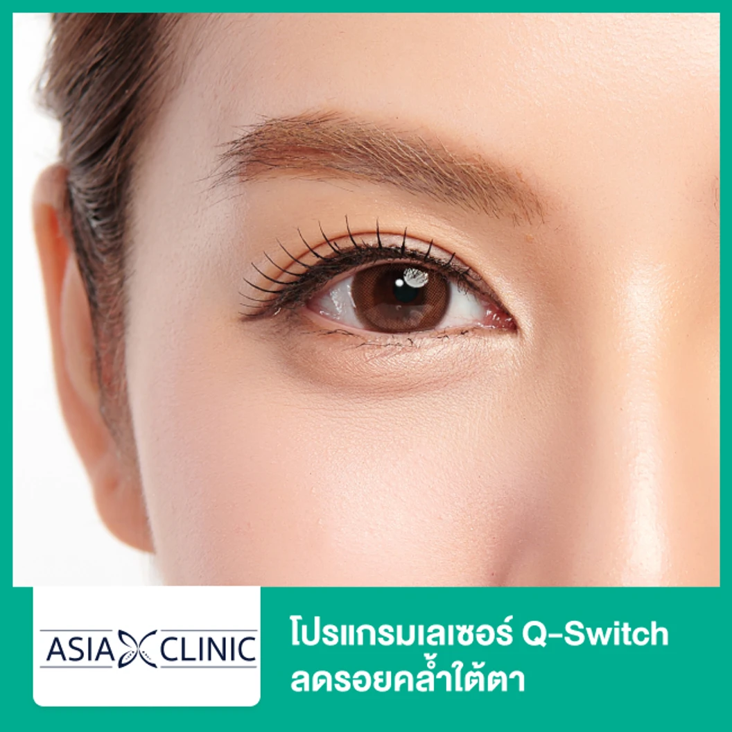 โปรแกรมเลเซอร์ Q-Switch ลดรอยคล้ำใต้ตา