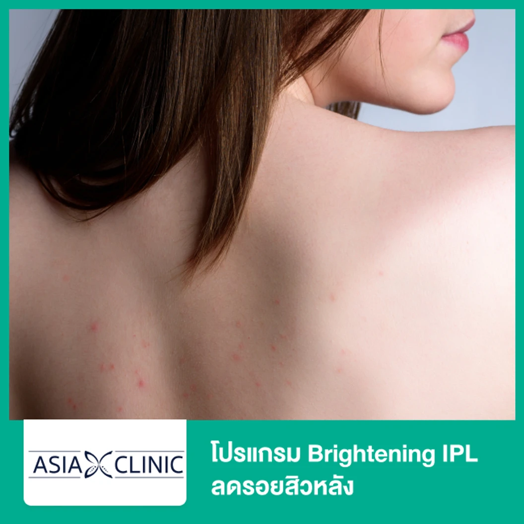 โปรแกรม Brightening IPL ลดรอยสิวหลัง