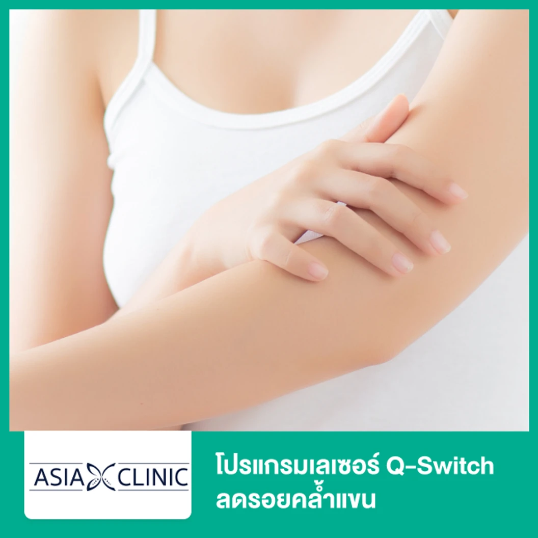 โปรแกรมเลเซอร์ Q-Switch ลดรอยคล้ำแขน