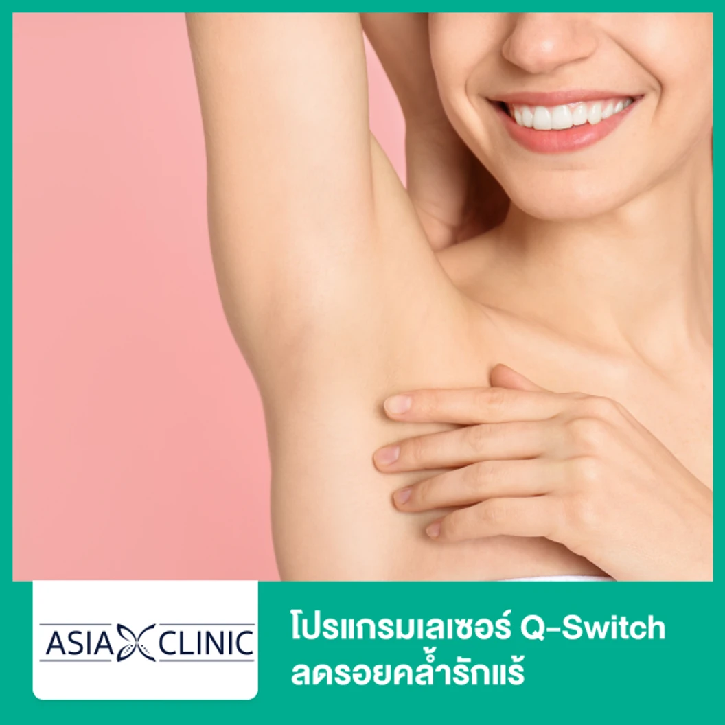 โปรแกรมเลเซอร์ Q-Switch ลดรอยคล้ำรักแร้