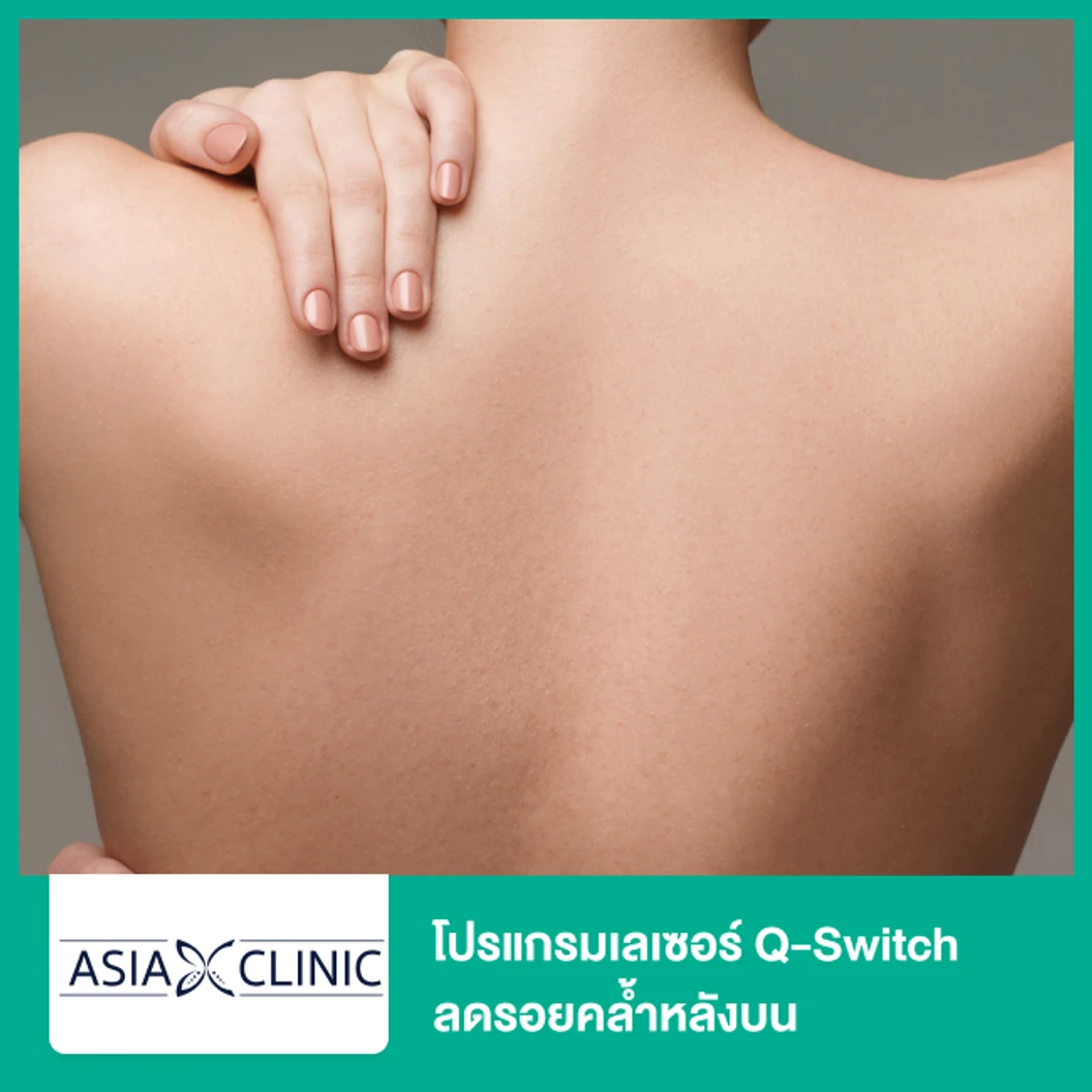 โปรแกรมเลเซอร์ Q-Switch ลดรอยคล้ำหลังบน