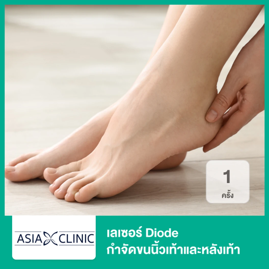 เลเซอร์ Diode กำจัดขนนิ้วเท้าและหลังเท้า 1 ครั้ง
