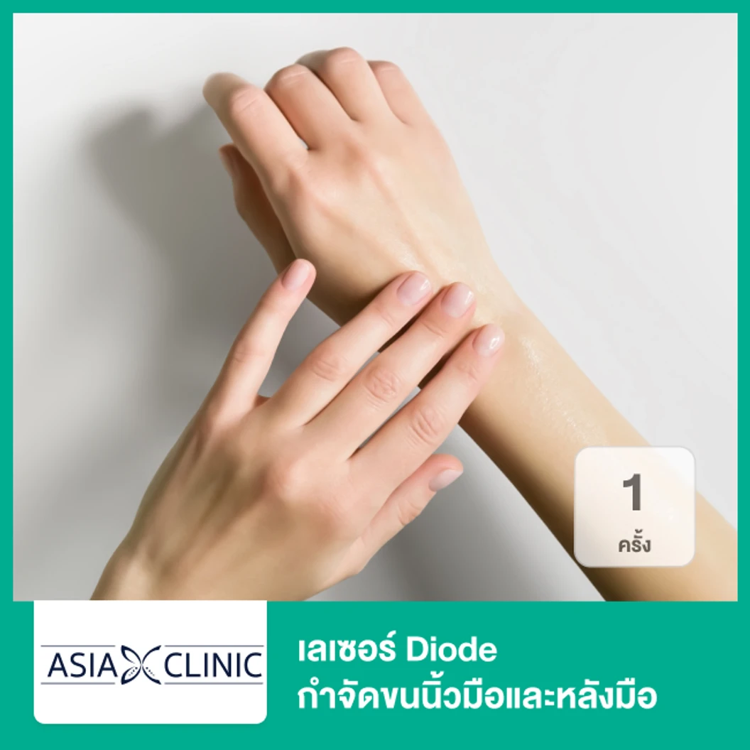 เลเซอร์ Diode กำจัดขนนิ้วมือและหลังมือ 1 ครั้ง