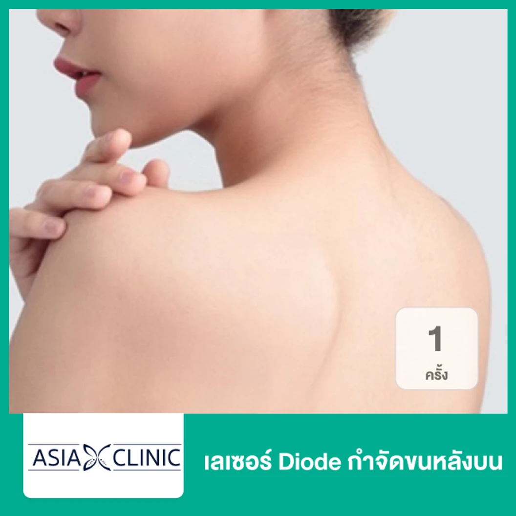เลเซอร์ Diode กำจัดขนหลังบน 1 ครั้ง