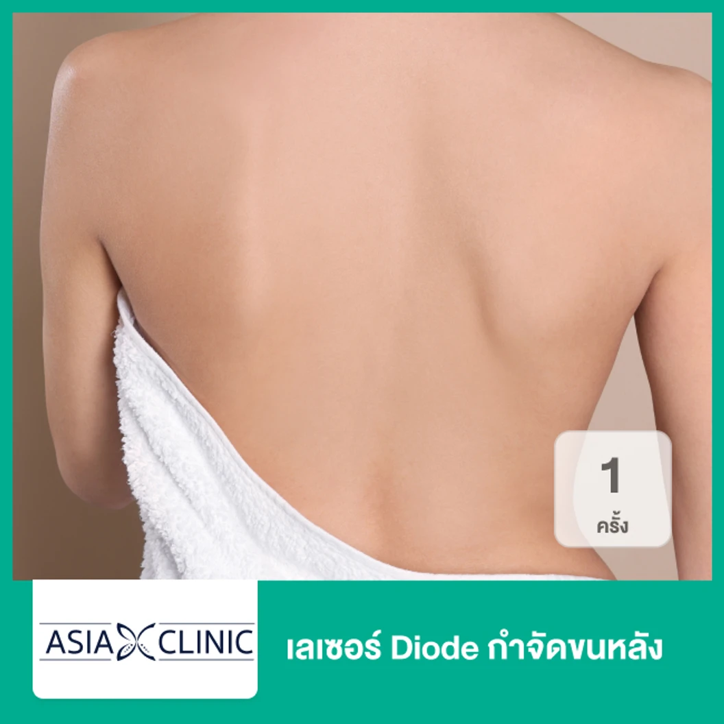 เลเซอร์ Diode กำจัดขนหลัง 1 ครั้ง