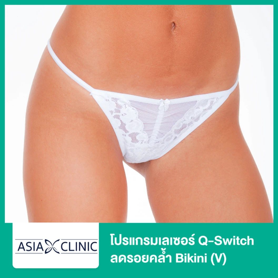 โปรแกรมเลเซอร์ Q-Switch ลดรอยคล้ำ Bikini (V)