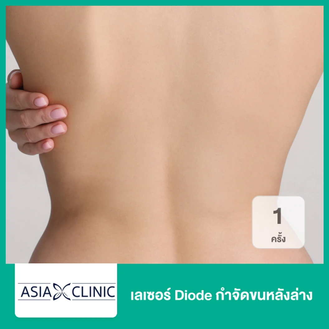 เลเซอร์ Diode กำจัดขนหลังล่าง 1 ครั้ง