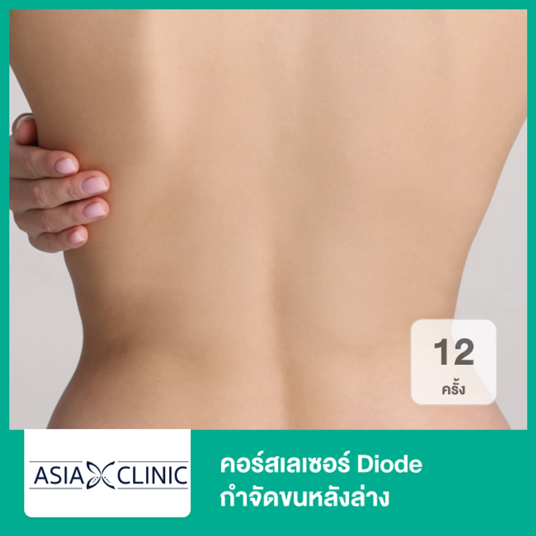 คอร์สเลเซอร์ Diode กำจัดขนหลังล่าง 12 ครั้ง