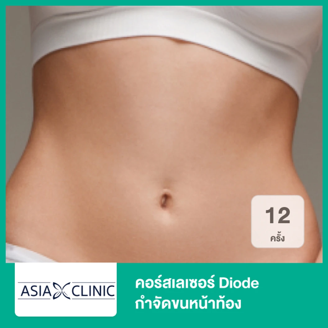 คอร์สเลเซอร์ Diode กำจัดขนหน้าท้อง 12 ครั้ง