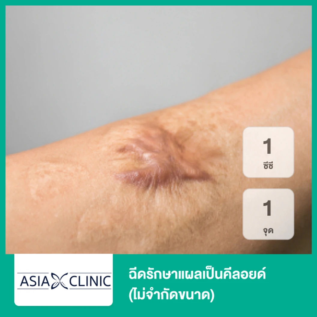 ฉีดรักษาแผลเป็นคีลอยด์ 1 ซีซี 1 จุด (ไม่จำกัดขนาด)