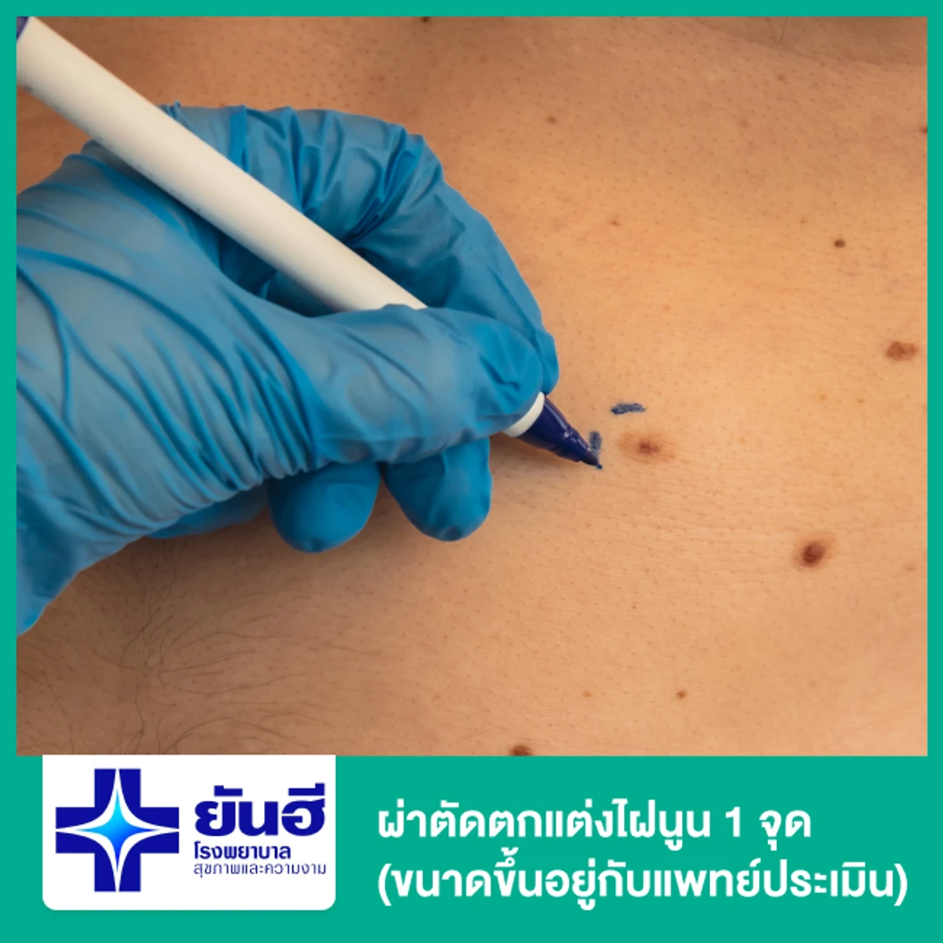 ผ่าตัดตกแต่งไฝนูน 1 จุด (ขนาดขึ้นอยู่กับแพทย์ประเมิน)