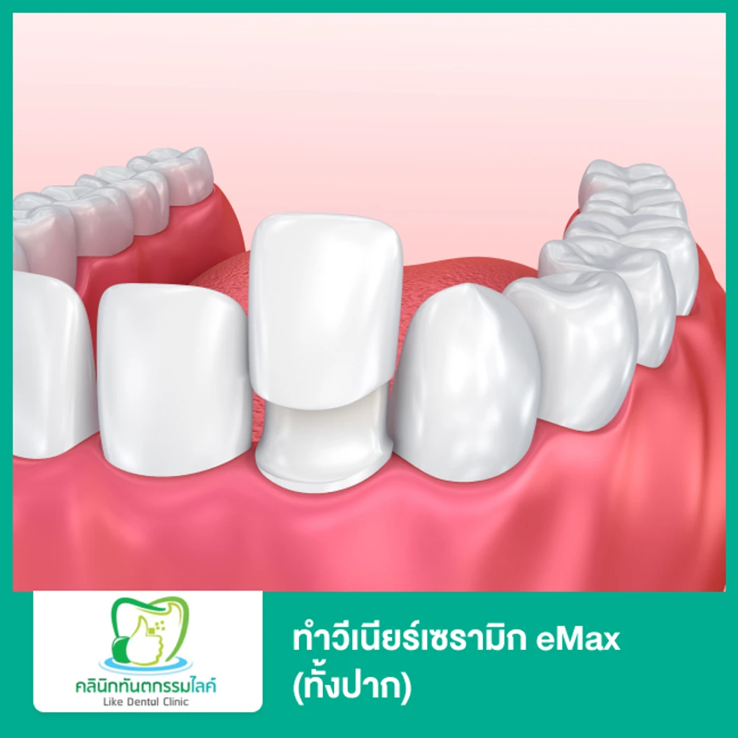 ทำวีเนียร์เซรามิก eMax (ทั้งปาก)