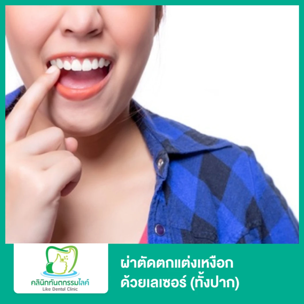 ผ่าตัดตกแต่งเหงือก ด้วยเลเซอร์ (ทั้งปาก)