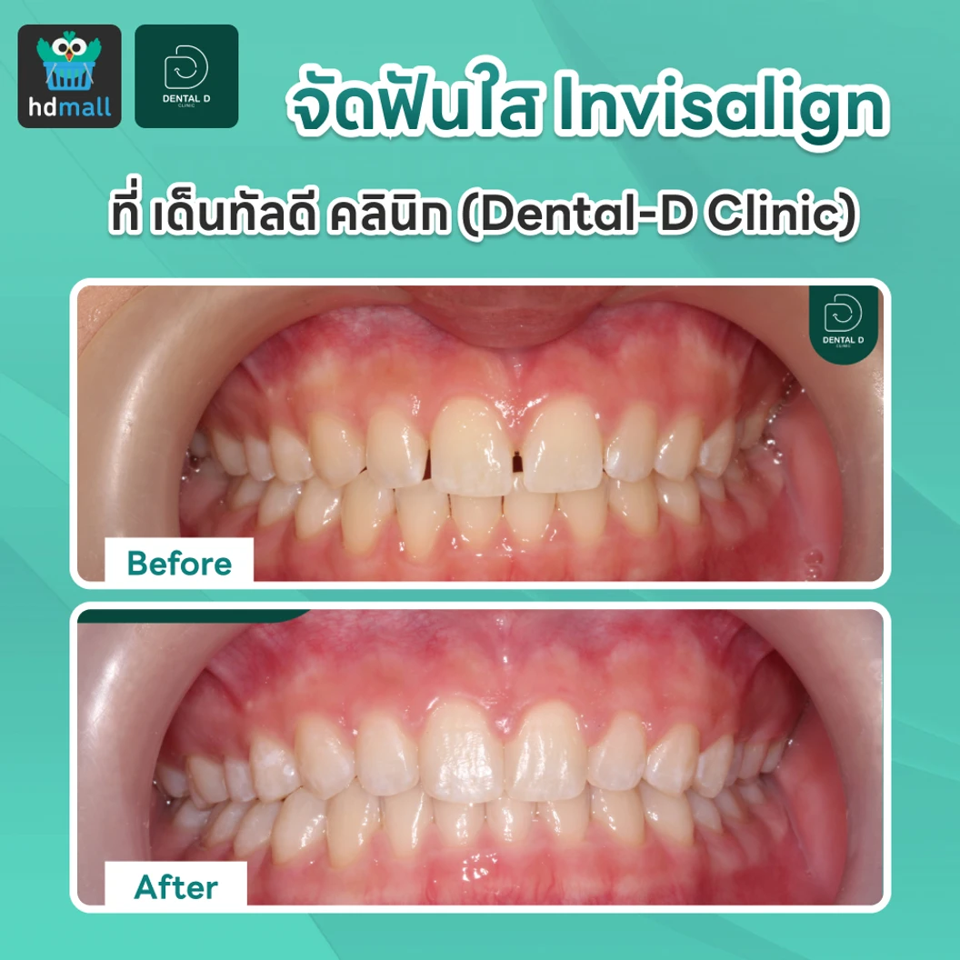 จัดฟันใส Invisalign Comprehensive 1 ฟันบนและล่าง ไม่จำกัดชิ้นงาน 3 ปี