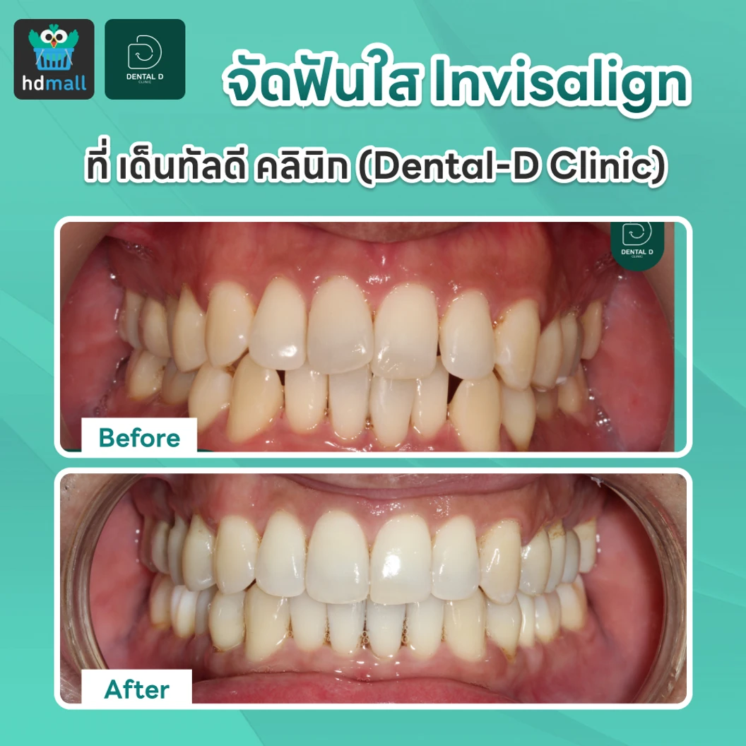 จัดฟันใส Invisalign Comprehensive 1 ฟันบนและล่าง ไม่จำกัดชิ้นงาน 3 ปี