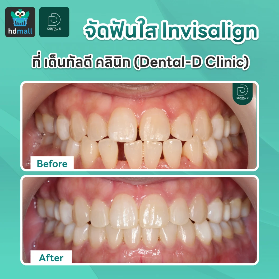 จัดฟันใส Invisalign Comprehensive 1 ฟันบนและล่าง ไม่จำกัดชิ้นงาน 3 ปี