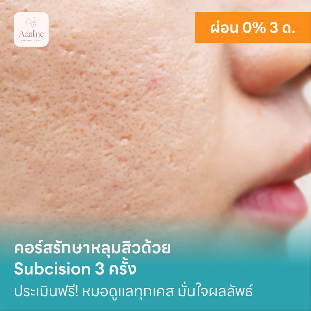คอร์สรักษาหลุมสิวด้วย Subcision 3 ครั้ง