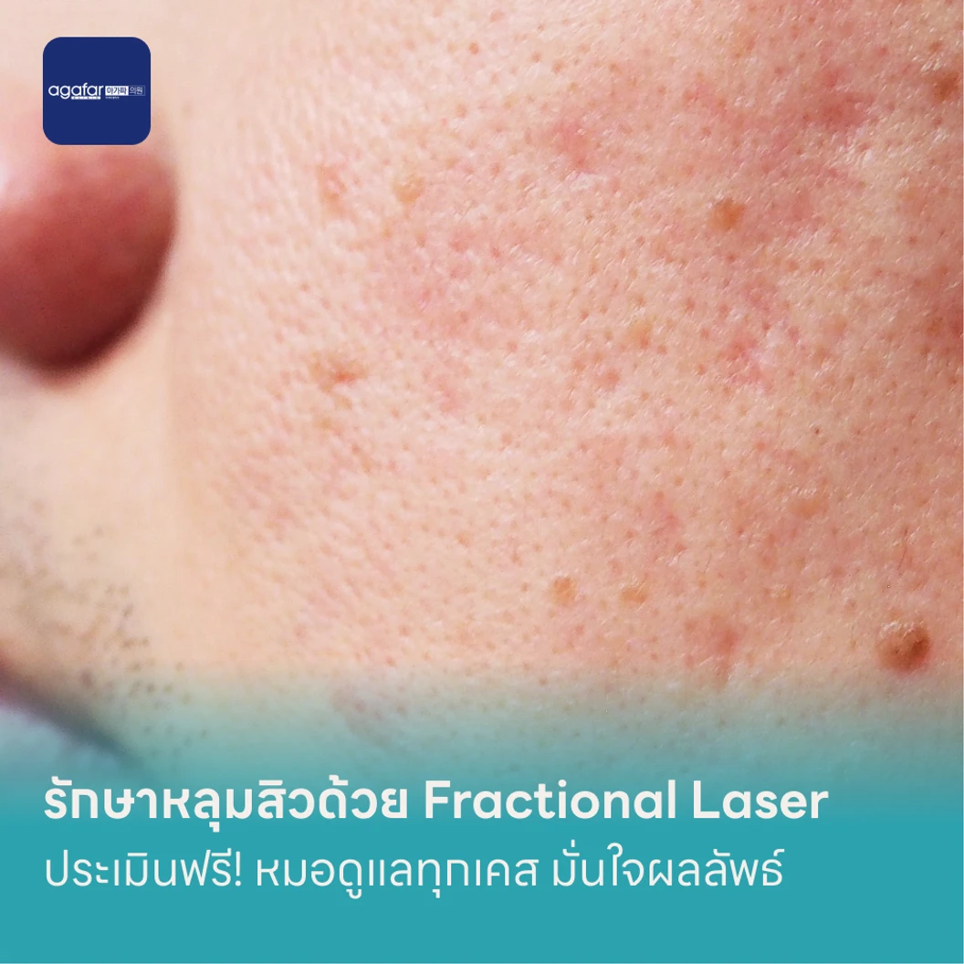 รักษาหลุมสิวด้วย Fractional Laser