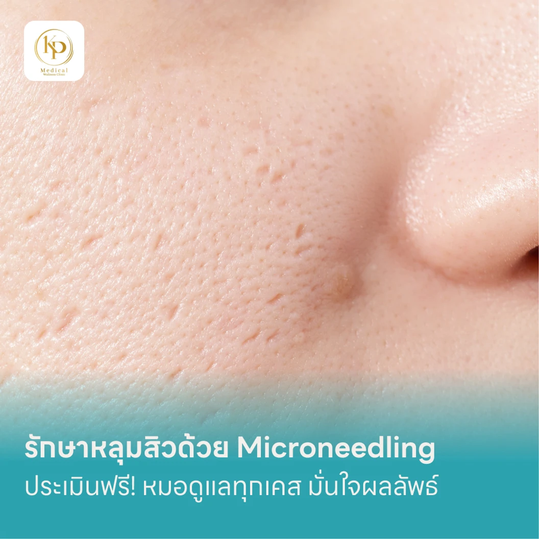 รักษาหลุมสิวด้วย Microneedling 1 บริเวณ 1 ครั้ง