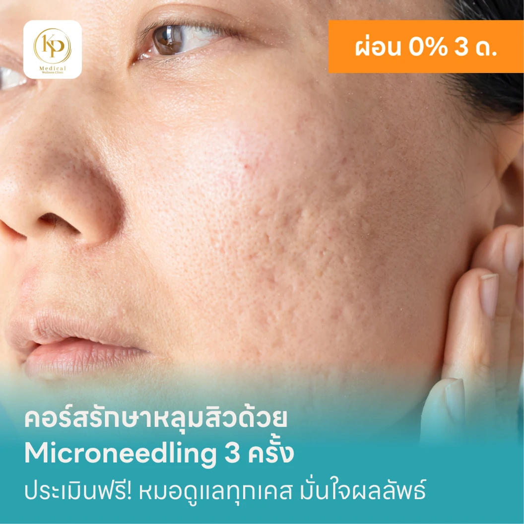 คอร์สรักษาหลุมสิวด้วย Microneedling 1 บริเวณ 3 ครั้ง