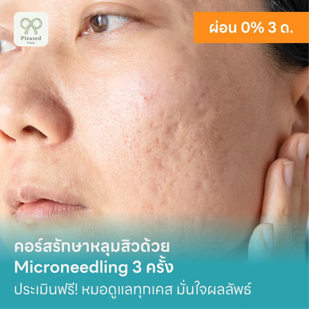คอร์สรักษาหลุมสิวด้วย Microneedling 3 ครั้ง