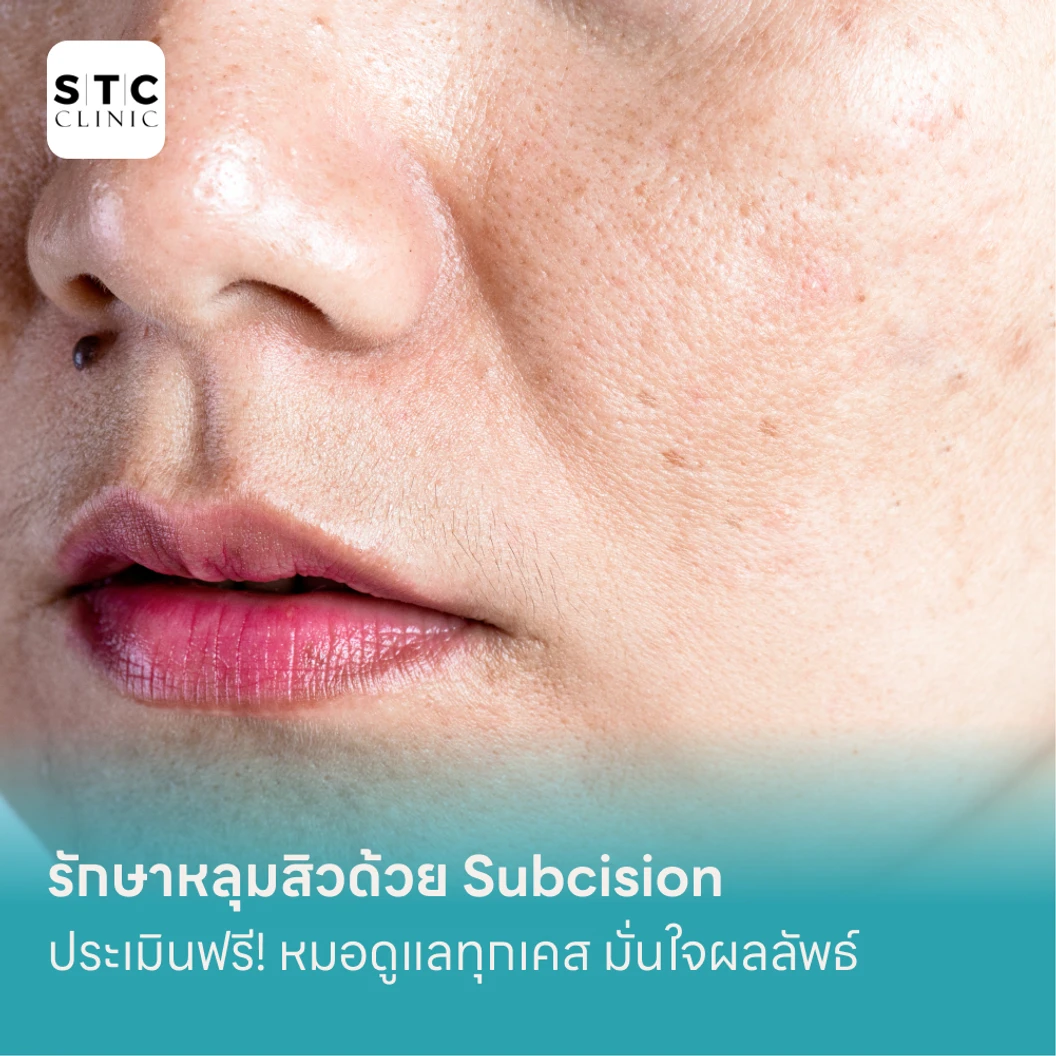 รักษาหลุมสิวด้วย Subcision