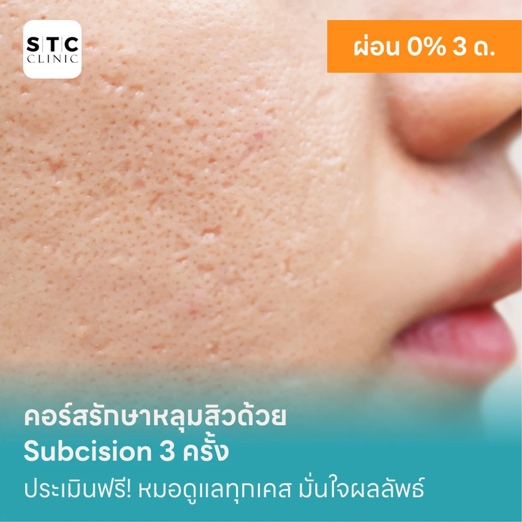 คอร์สรักษาหลุมสิวด้วย Subcision 3 ครั้ง